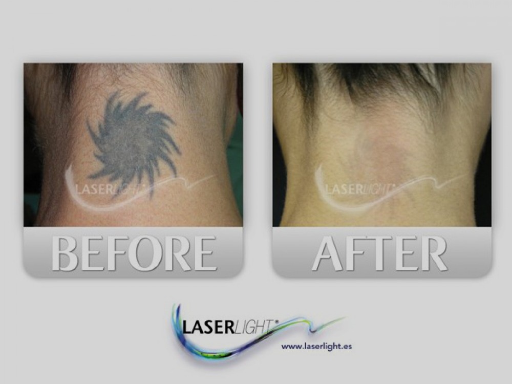 Eliminación tatuaje cuello por láser Laser Light 4 Barcelona Nou Barris Rise Tattoo
